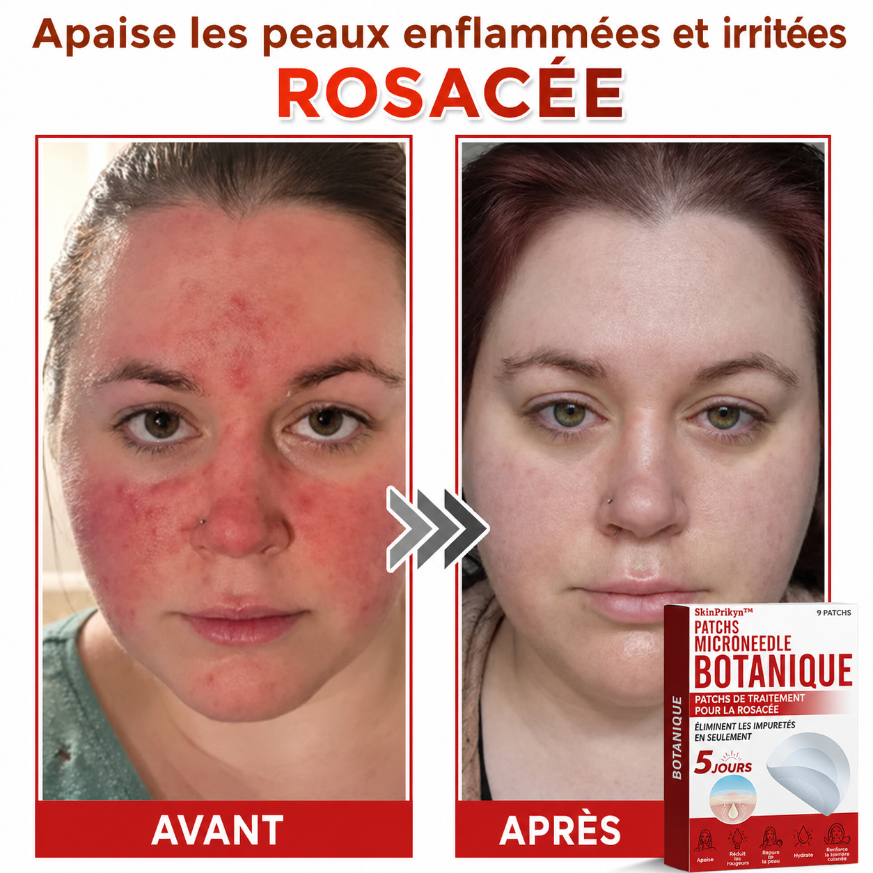 SkinPrikyn™ | Patch Botanique à Micro-Aiguilles pour une Peau Nette et Uniforme