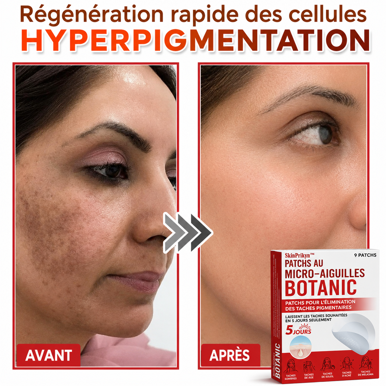 SkinPrikyn™ | Patch Botanique à Micro-Aiguilles pour une Peau Nette et Uniforme