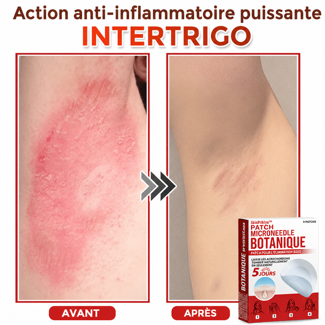 SkinPrikyn™ | Patch Botanique à Micro-Aiguilles pour une Peau Nette et Uniforme