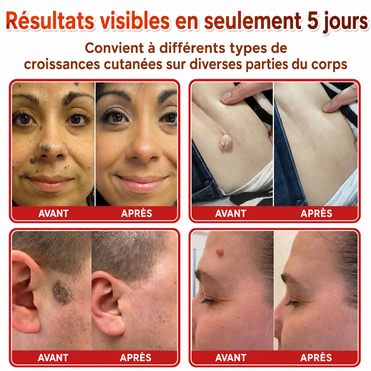 SkinPrikyn™ | Patch Botanique à Micro-Aiguilles pour une Peau Nette et Uniforme