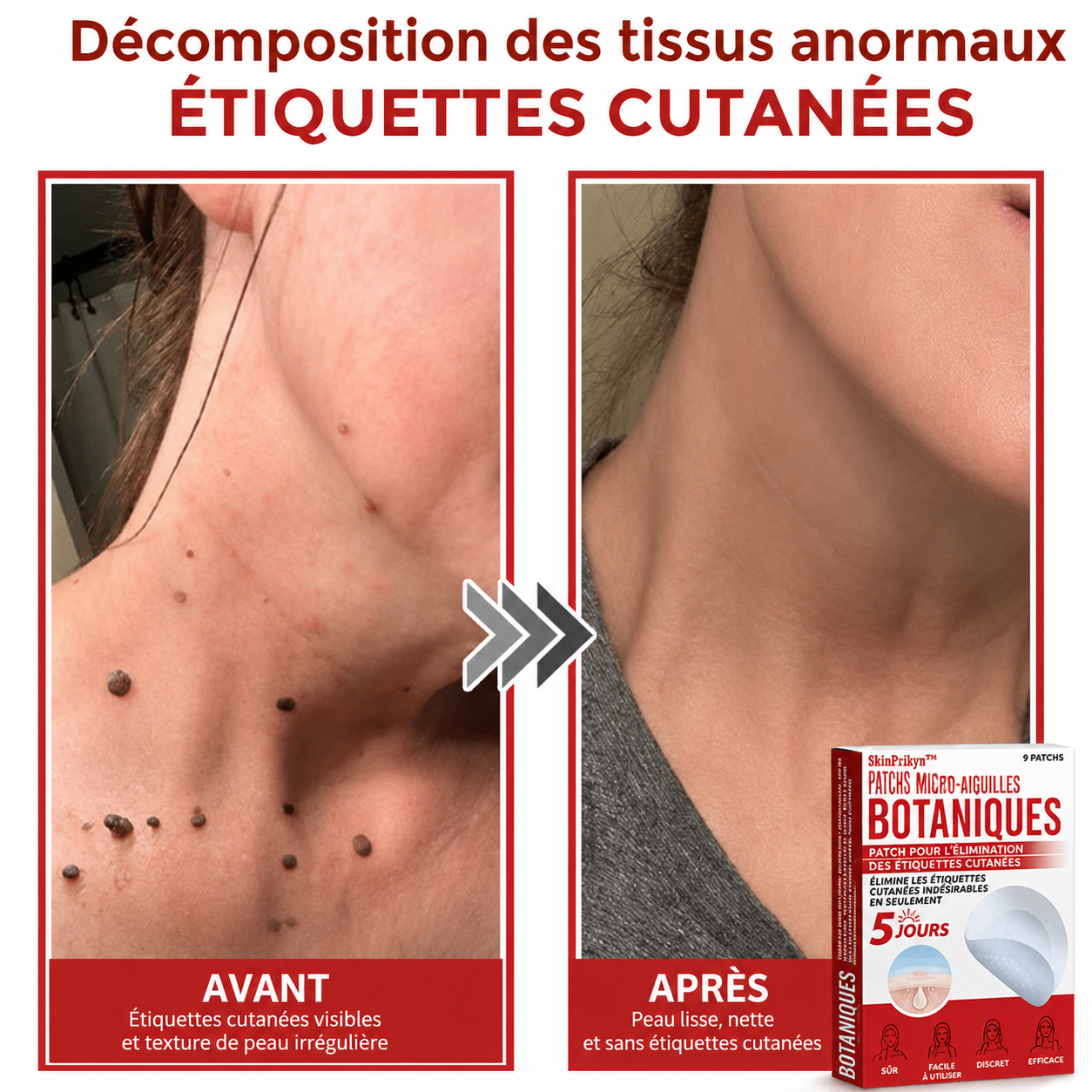 SkinPrikyn™ | Patch Botanique à Micro-Aiguilles pour une Peau Nette et Uniforme