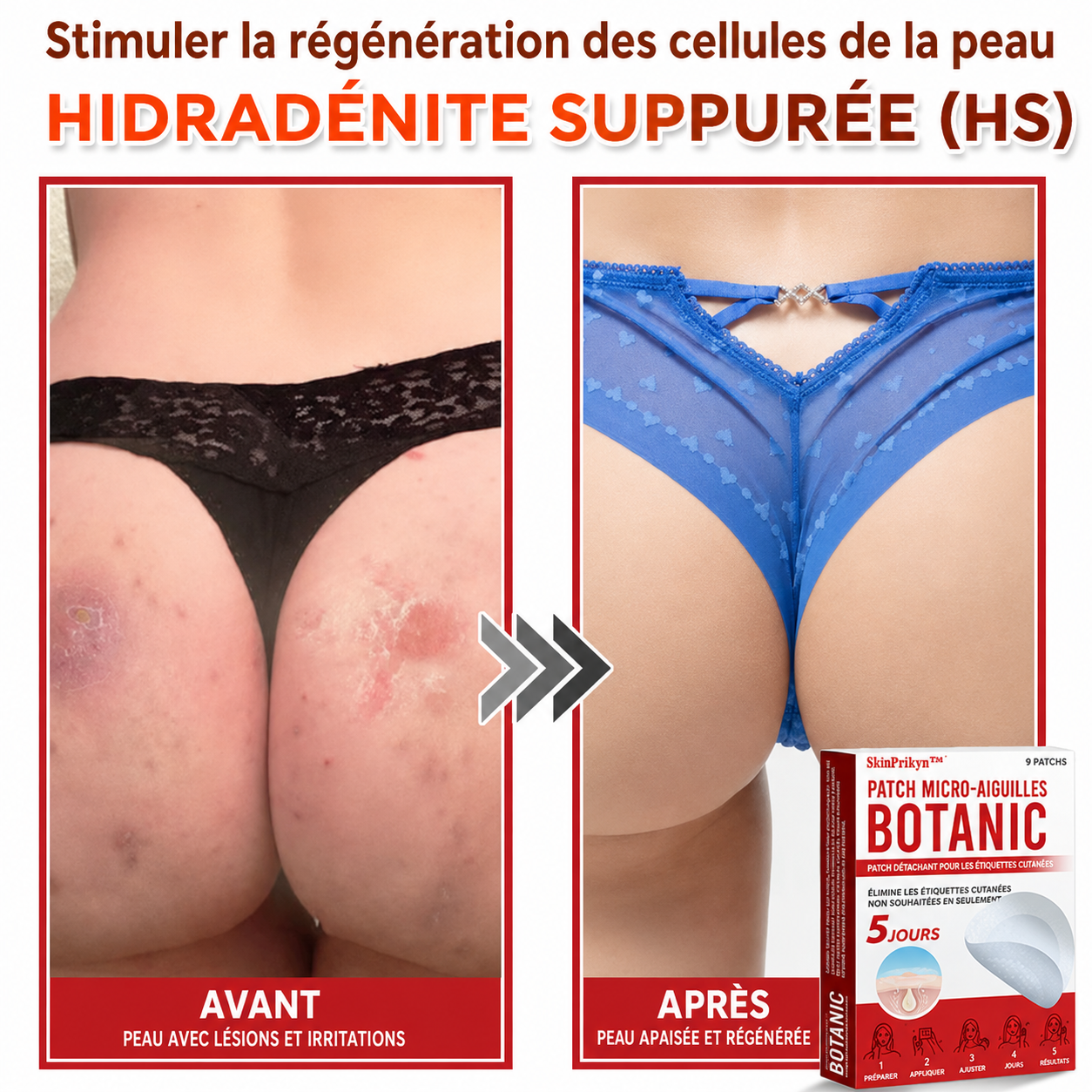 SkinPrikyn™ | Patch Botanique à Micro-Aiguilles pour une Peau Nette et Uniforme