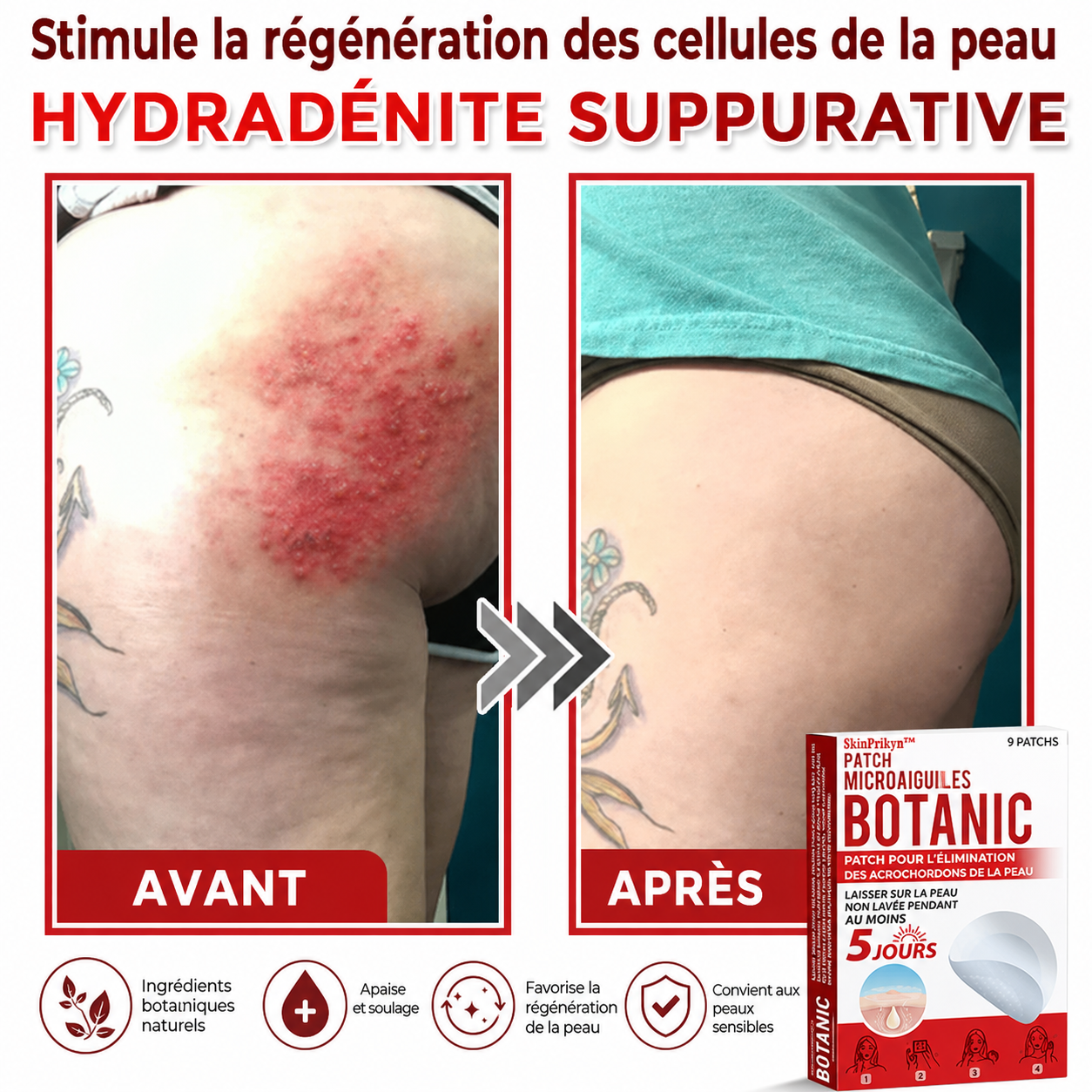 SkinPrikyn™ | Patch Botanique à Micro-Aiguilles pour une Peau Nette et Uniforme